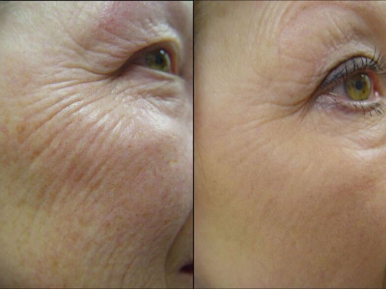 Avant et après le rajeunissement de la peau au laser - Réduit visiblement les rides