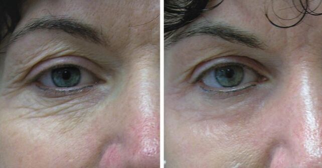 Laser de peau autour des yeux