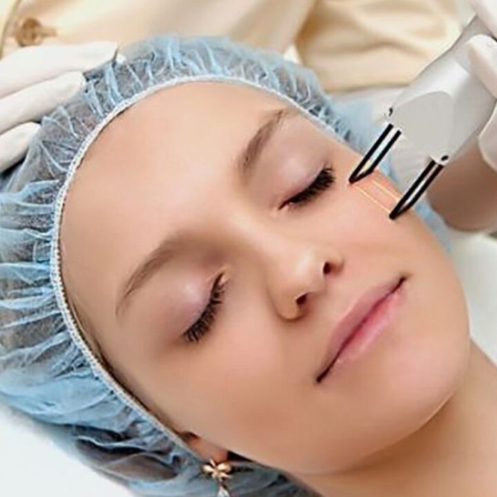 Revival de fraction laser