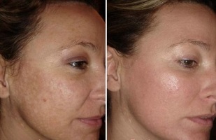 Rajeunissement du visage au laser avant et après les photos
